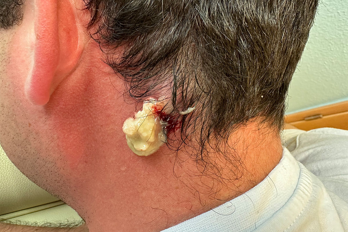 hno-praxis-chemnitz-atherom-op-IMG_4573 HNO-Praxis Chemnitz: Atherom OP