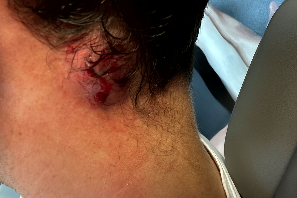 hno-praxis-chemnitz-atherom-op-IMG_4574 HNO-Praxis Chemnitz: Atherom OP (nachher)