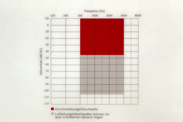 Knochenleitungsimplantat: Diagramm 3: Knochenleitungshörschwelle/Luftleitungshörschwelle