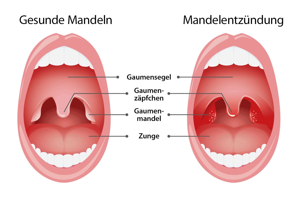 Mandelentzündung - Symbolgrafik (Quelle: www.medizin.plus, bearbeitet)