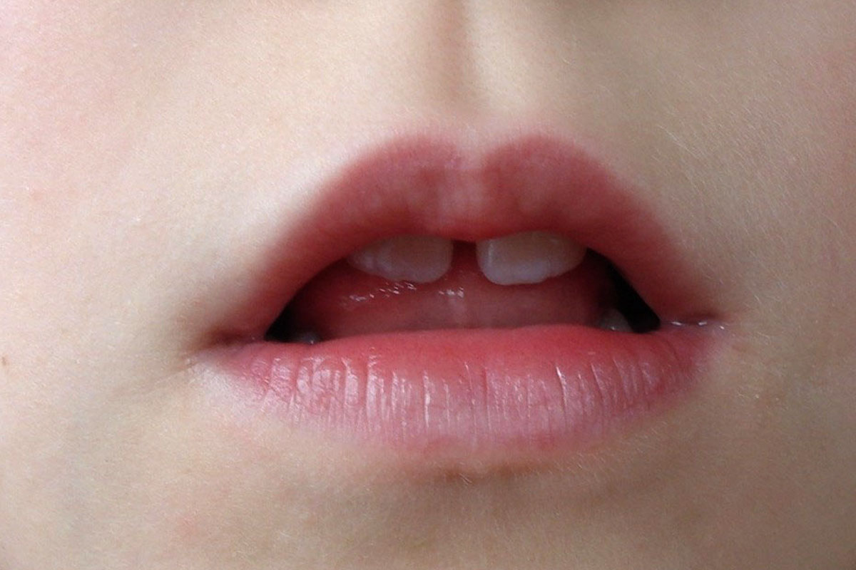 Myofunktionelle Störungen bei Kindern: offener Mund