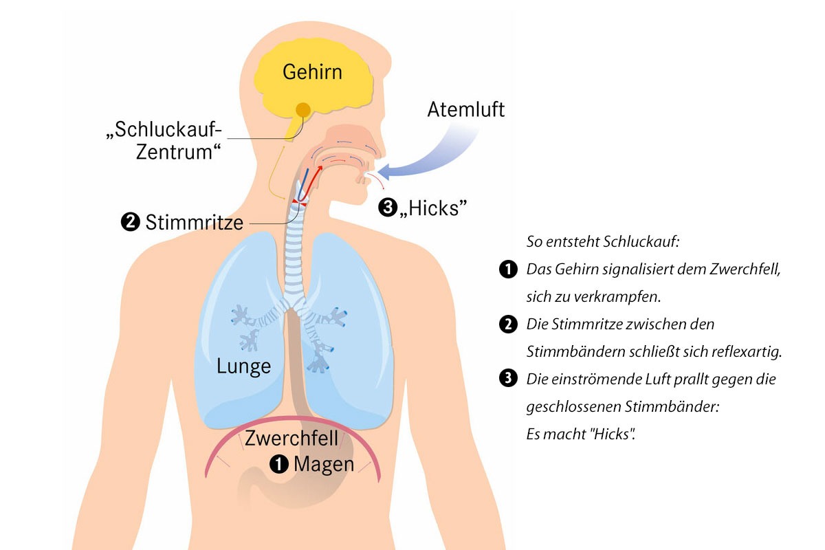 Schluckauf (schematische Darstellung)