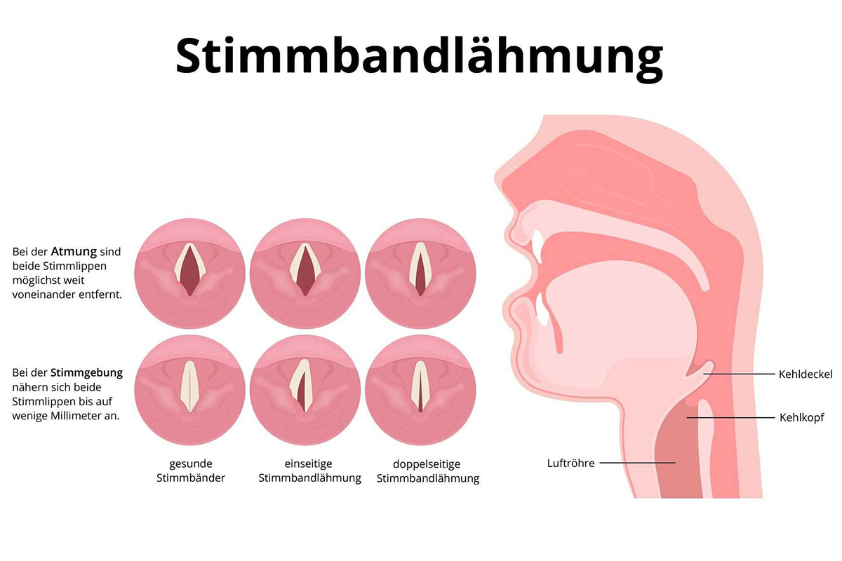 Stimmbandlähmung (Rekurrenzparese) (schematische grafische Darstellung)