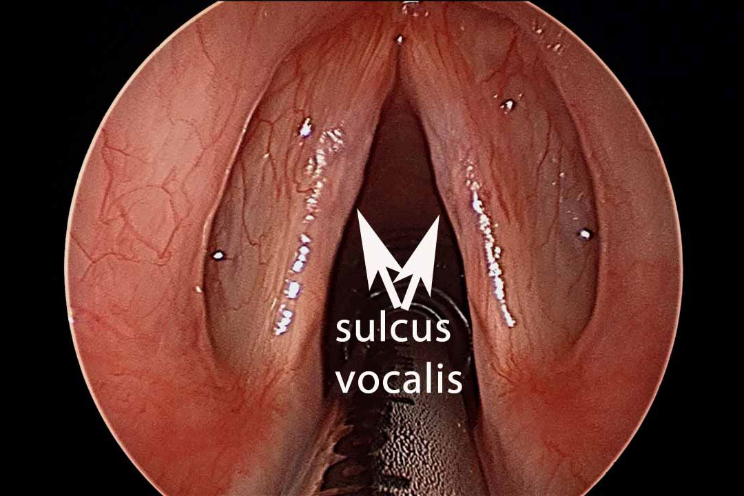 Stimmlippenfurche (Sulcus vocalis)