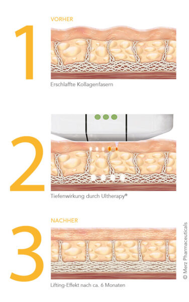 Merz Aesthetics Ultherapy®: Lifting-Effekt